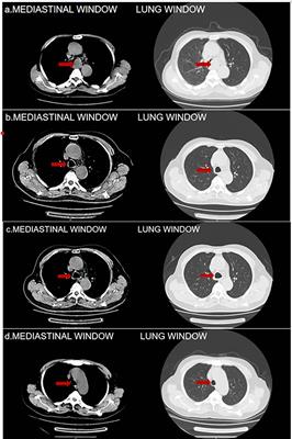 Case report: A novel perspective on the treatment of primary tracheal small cell carcinoma: a patient’s experience with immuno-combined EP therapy and literature review